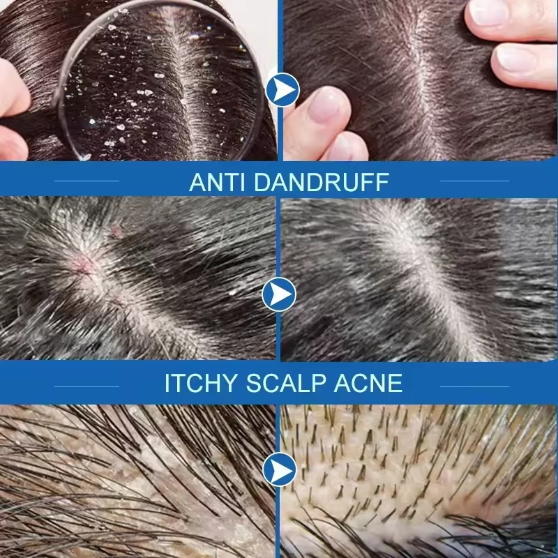 Fast Anti Dandruff Hair Treatm - Castor Oil Soap 리뷰 및 가격