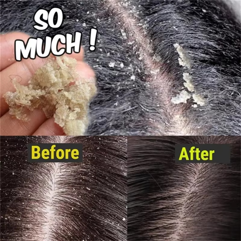 Fast Anti Dandruff Hair Treatm - Castor Oil Soap 리뷰 및 가격